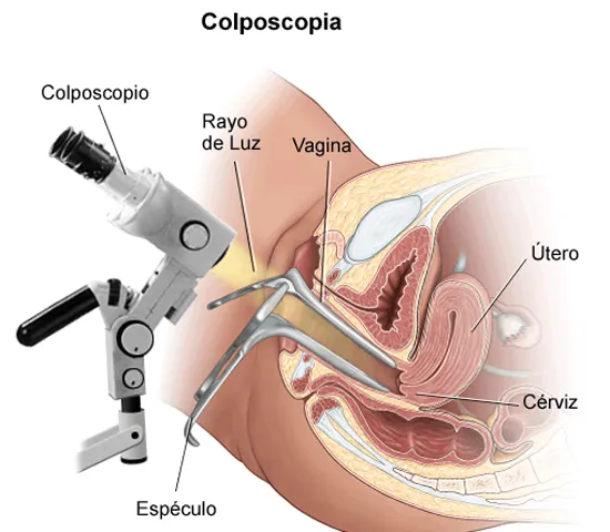 Lavoisier - 💁🏽‍♀️ A Colposcopia é um exame ginecológico